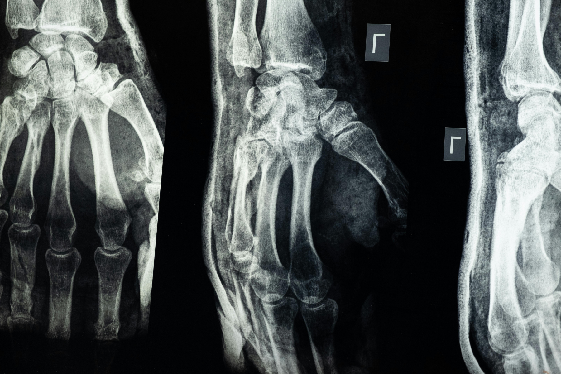 X Ray showing bones in hands. 
